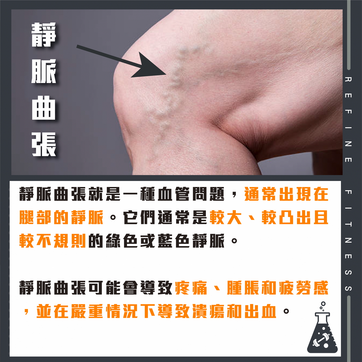 靜脈曲張凸出且不規則